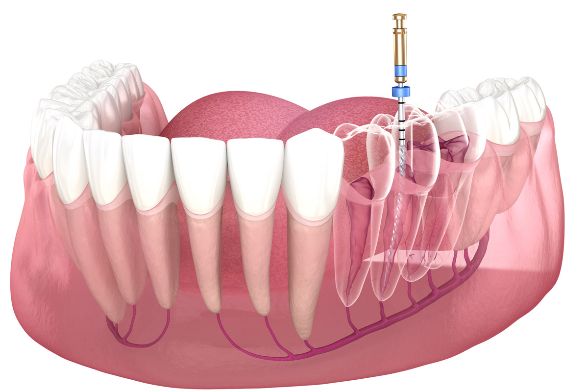 Tecnica di trattamento dentale meccanico (endodonzia meccanica)