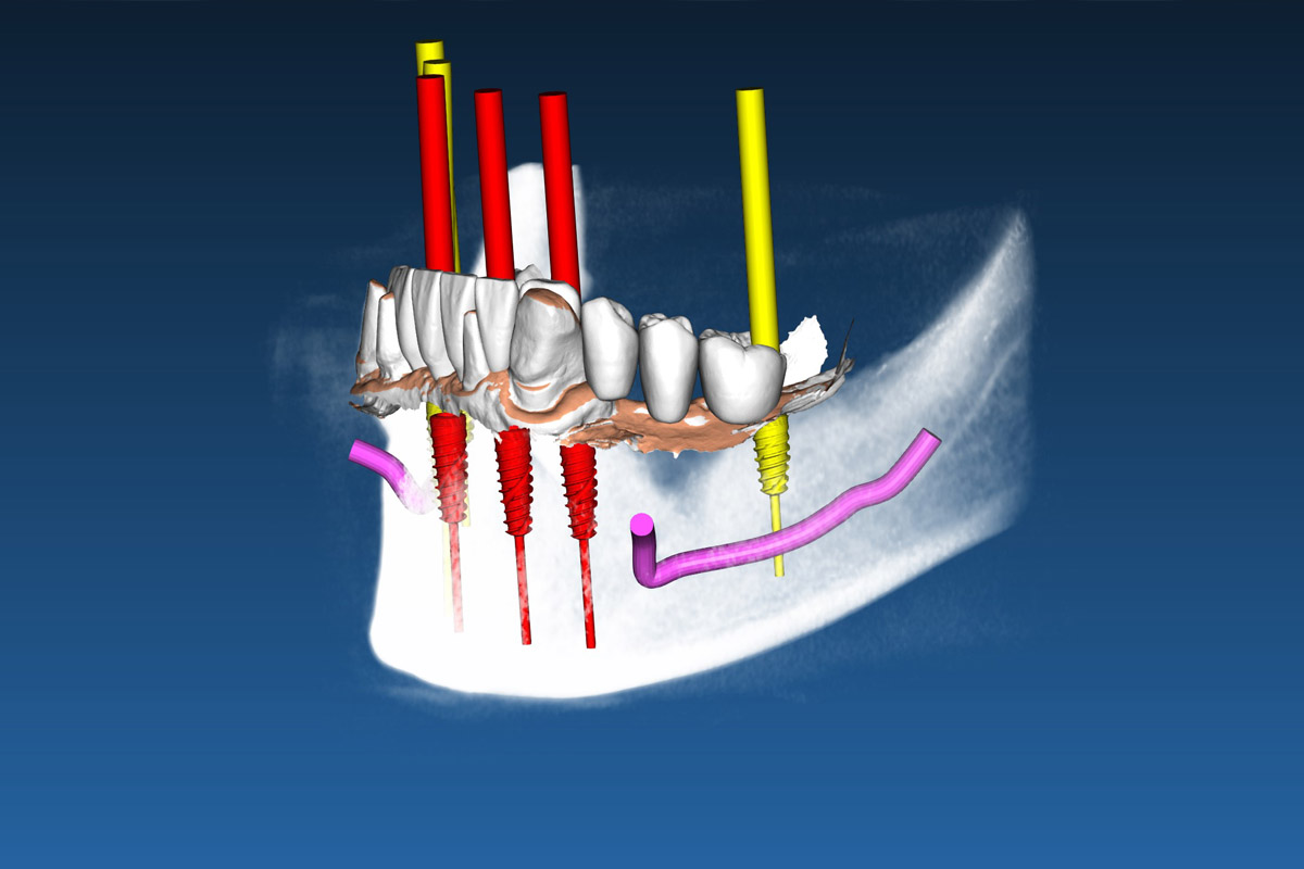 Guided Implantology