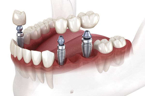 Mancanza di più denti