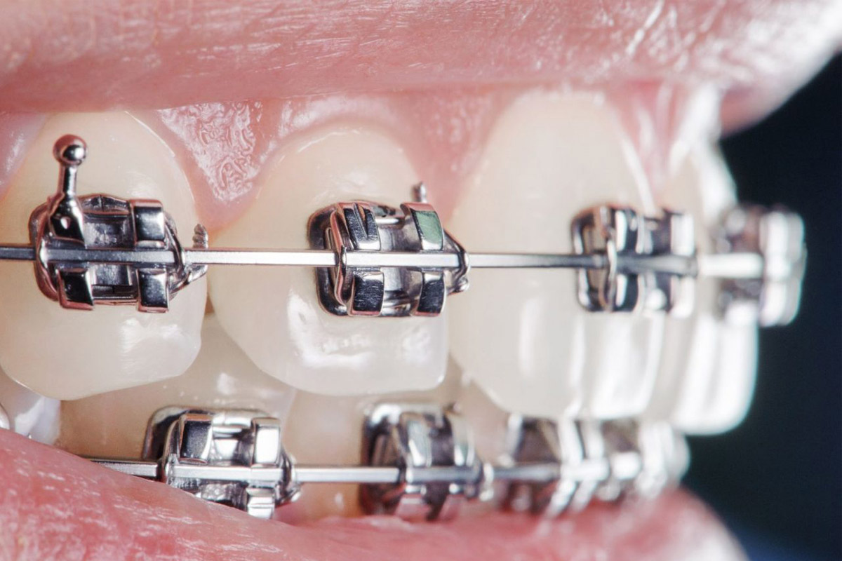 Terapia ortodontica fissa